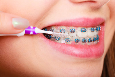 How Do Braces Actually Straighten Teeth?