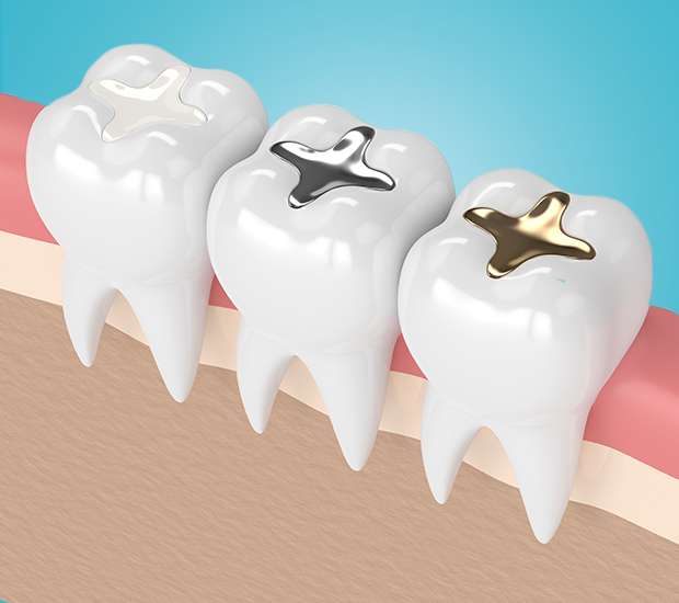 Livermore Composite Fillings