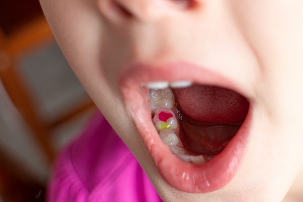 Treating A Cavity With A Dental Filling