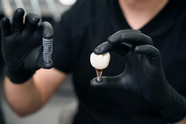 Is Tooth Extraction Necessary Before Receiving Dental Implants?