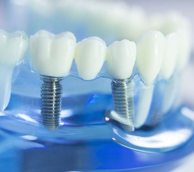 Livermore Dental Implants