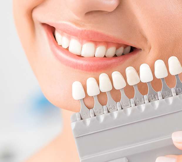 Livermore Dental Veneers and Dental Laminates