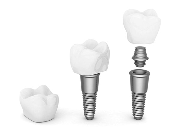 Implant Dentist in Livermore CA