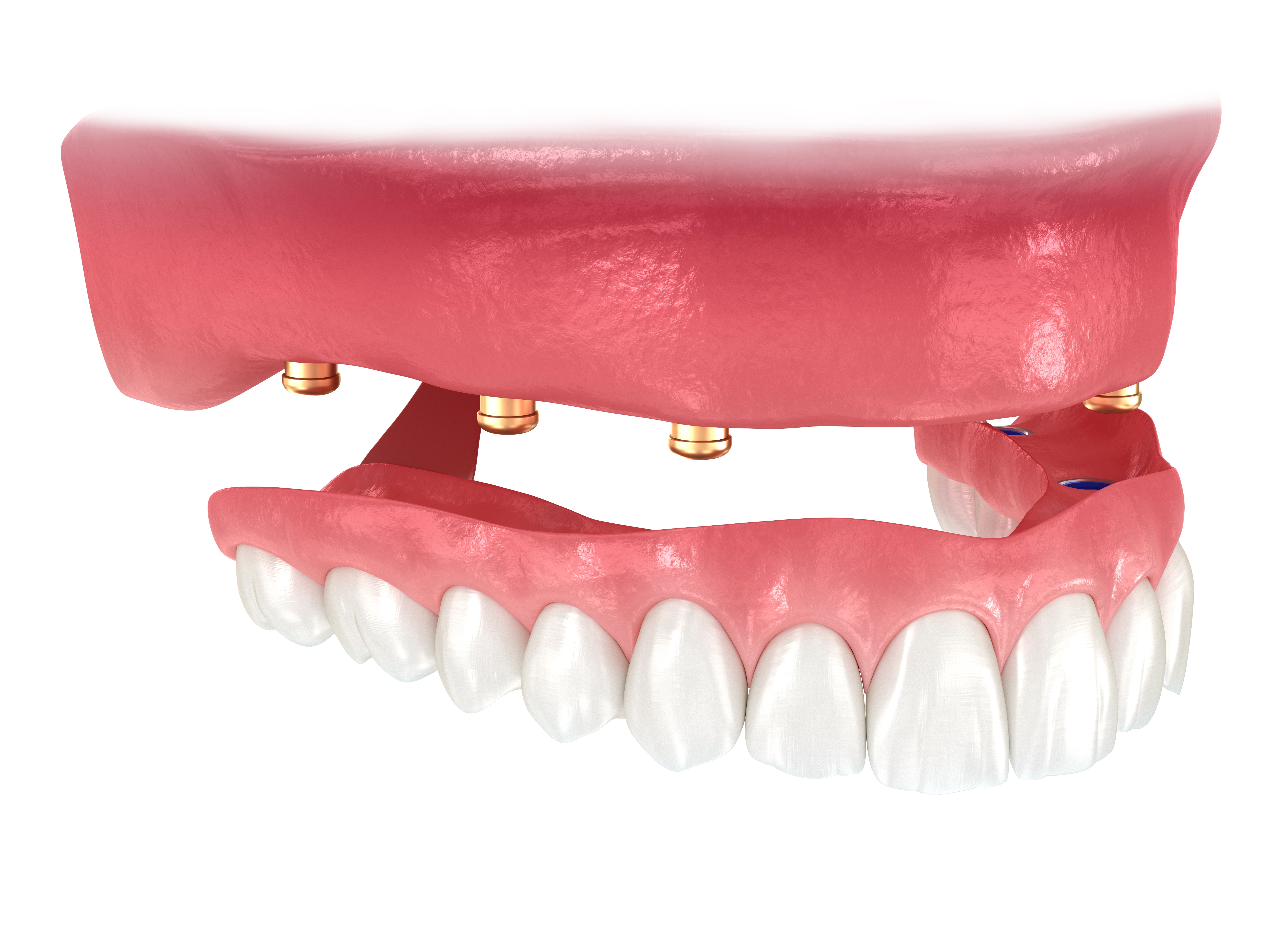 Implant Supported Dentures Livermore, CA