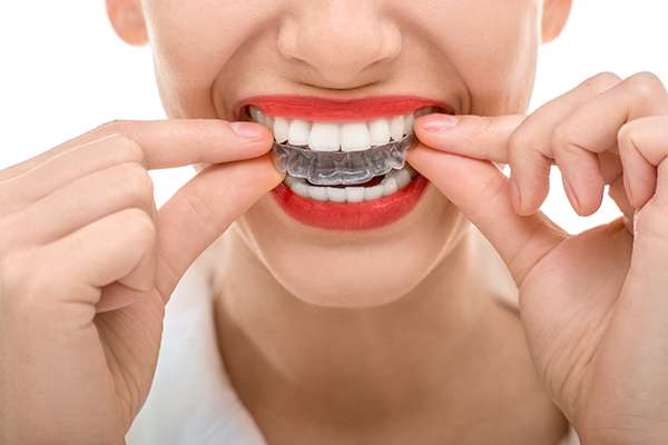 Invisalign Dentist in Livermore CA