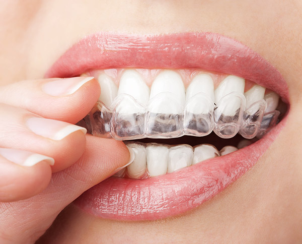 Invisalign Dentist in Livermore, CA