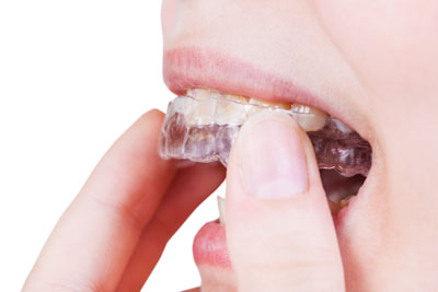 Invisalign