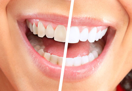 Types of Teeth Cleaning: Quadrant versus Standard - Vineyard Hills Dental  Care Livermore California