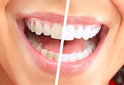 Types of Teeth Cleaning: Quadrant versus Standard - Vineyard Hills Dental Care Livermore California